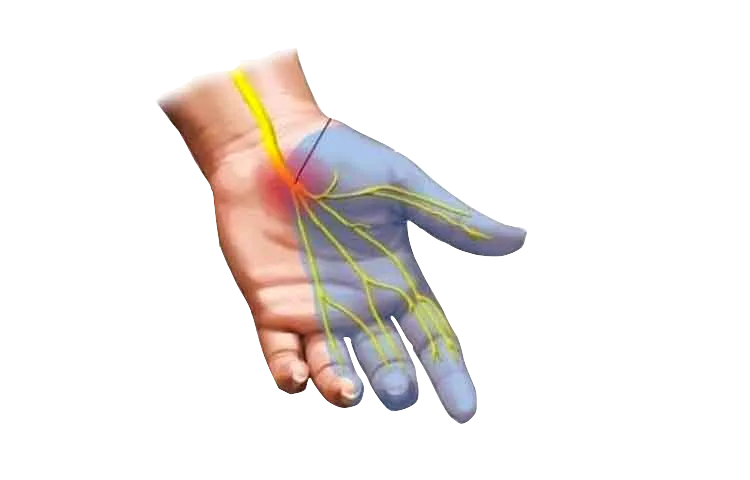 imagen de las areas más afectadas por el síndrome del túnel carpiano: los primeros tres dedos.