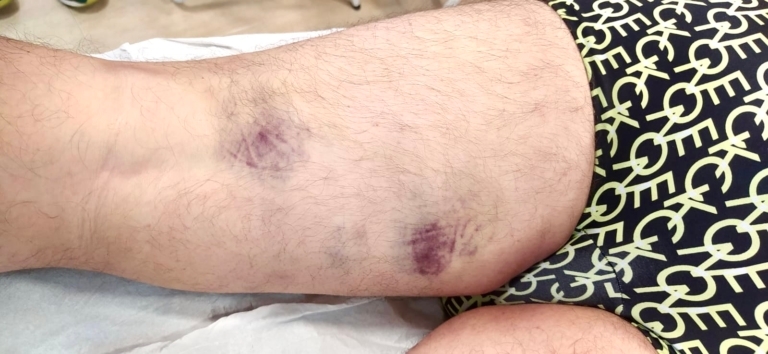 Hematomas por una lesión muscular
