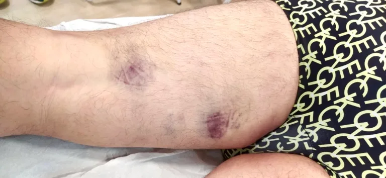 Hematomas por una lesión muscular