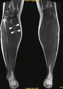 resonancia magnética que muestra una lesión muscular