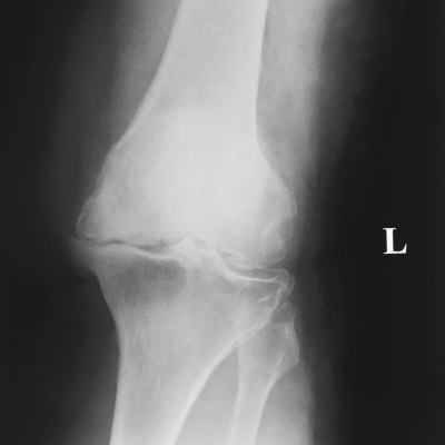 artrosis de rodilla fisioterapia